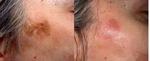 Actinic keratosis treatment before and after