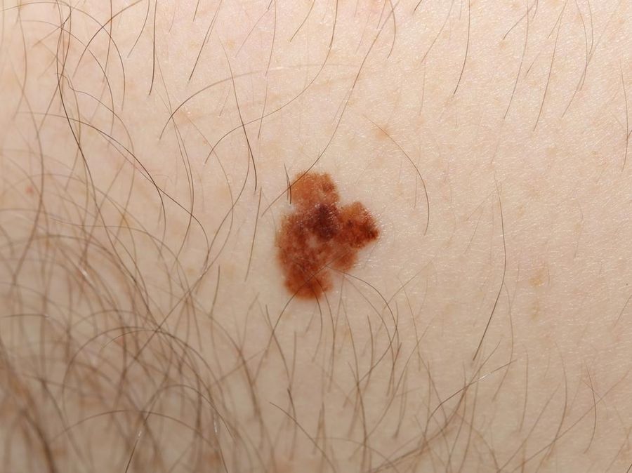 Melanoma — clinical example 1