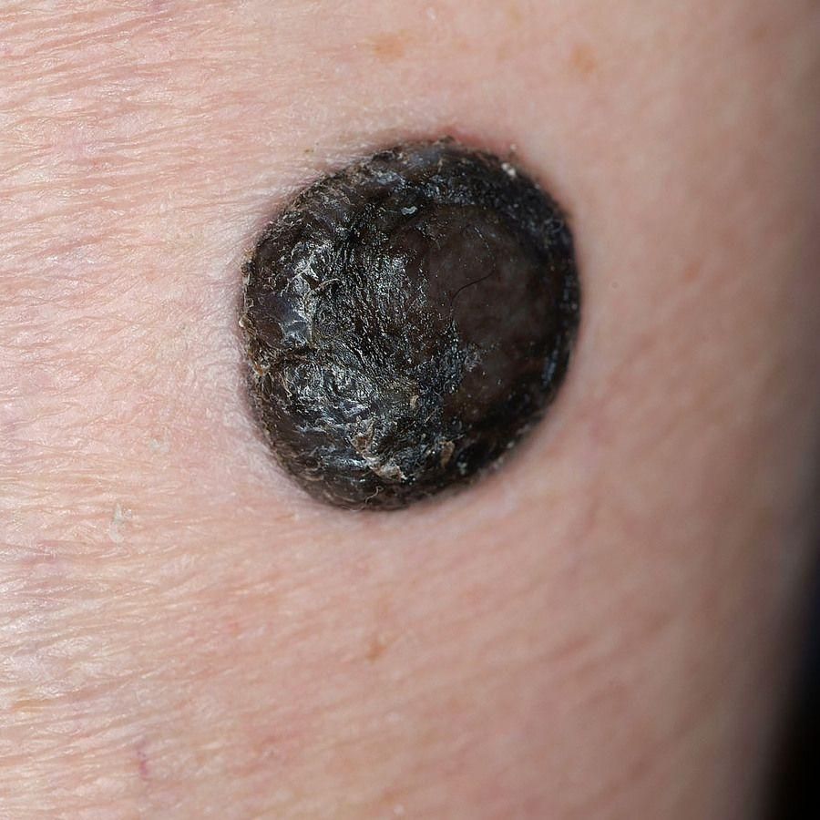 Melanoma — clinical example 2