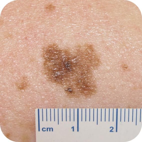 Superficial spreading melanoma — example 1