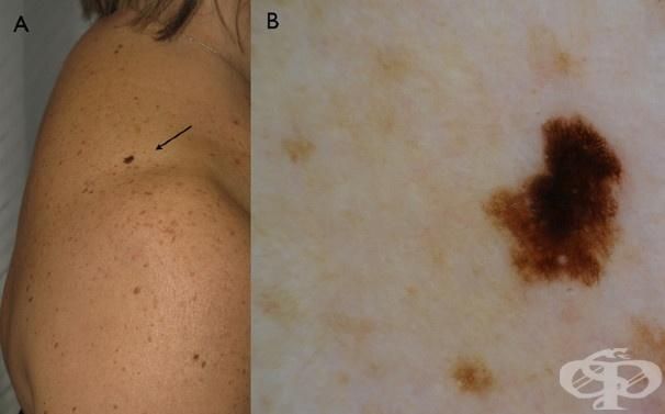 Superficial spreading melanoma — example 2