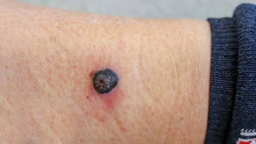 Nodular melanoma — example 1