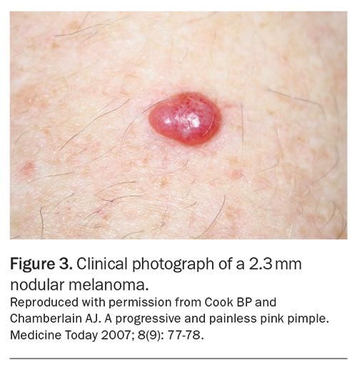Nodular melanoma — example 2