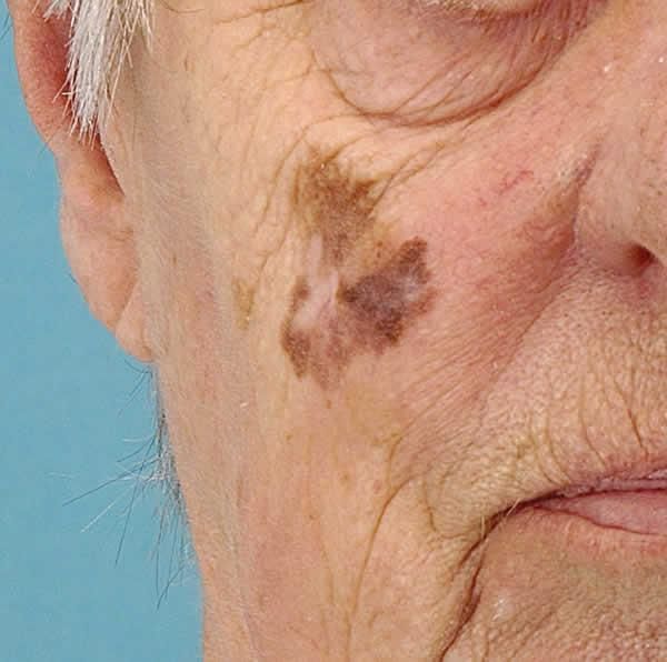 Lentigo maligna melanoma — example 1