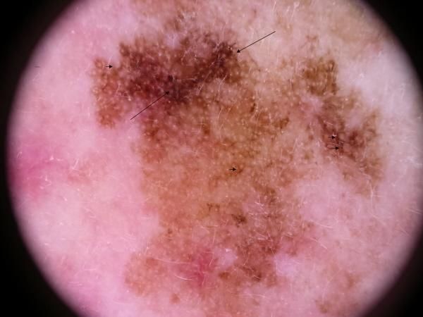 Lentigo maligna melanoma — example 2