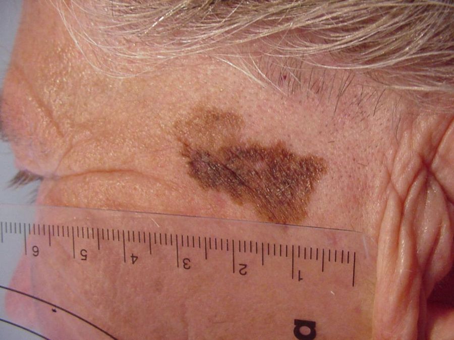 Lentigo maligna melanoma — example 3