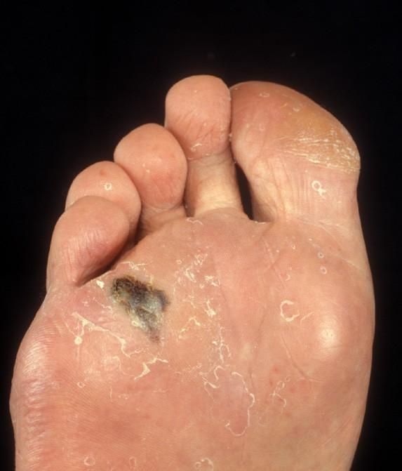 Acral lentiginous melanoma — example 3