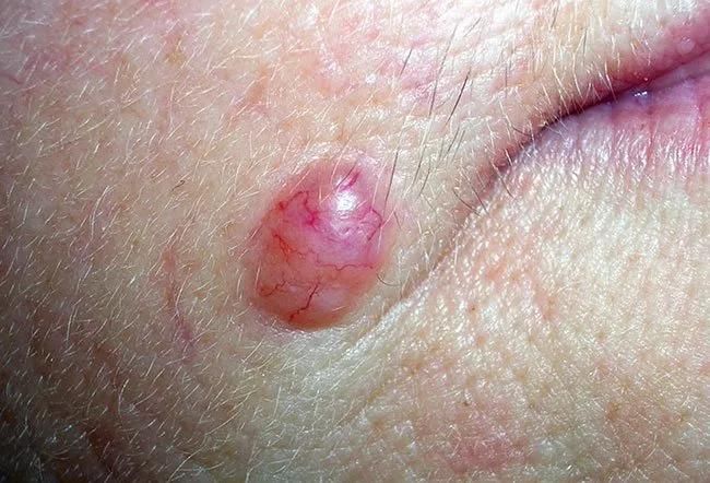 Nodular BCC — typical pearly translucent lump with telangiectasia