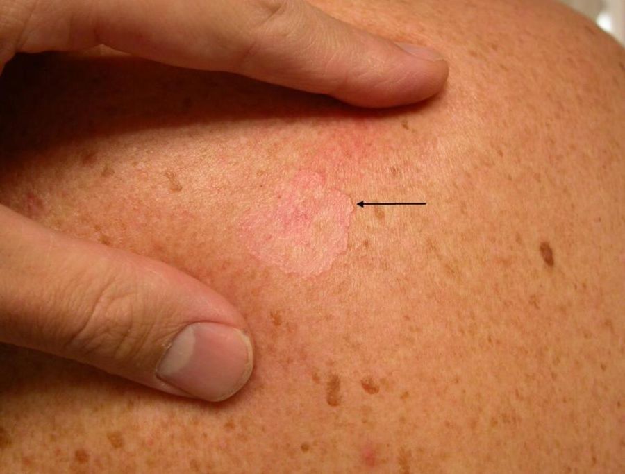 Superficial BCC — example 2