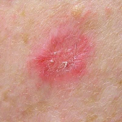 Superficial BCC — example 3