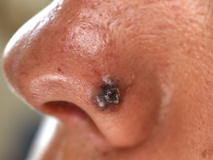Pigmented BCC — example 1