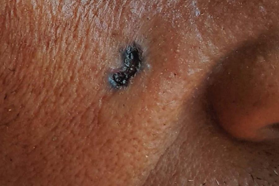 Pigmented BCC — example 3
