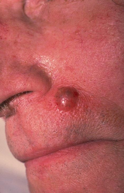 Pigmented BCC — example 4