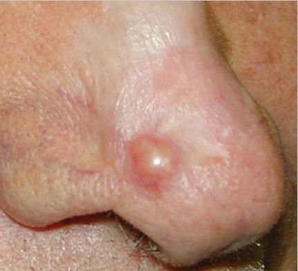 Nodular BCC — common presentation on the face