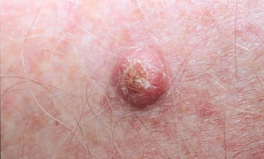 SCC — clinical example 1