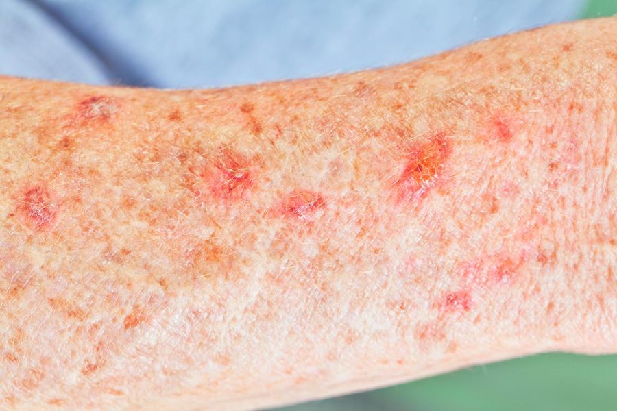 SCC risk factors — example 2