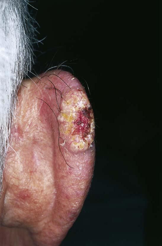 High-risk SCC — example 1