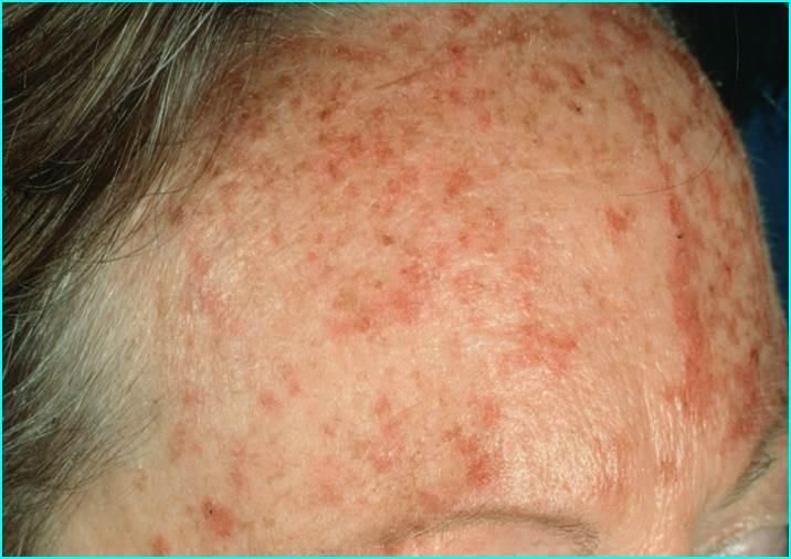 Actinic keratosis — example 1