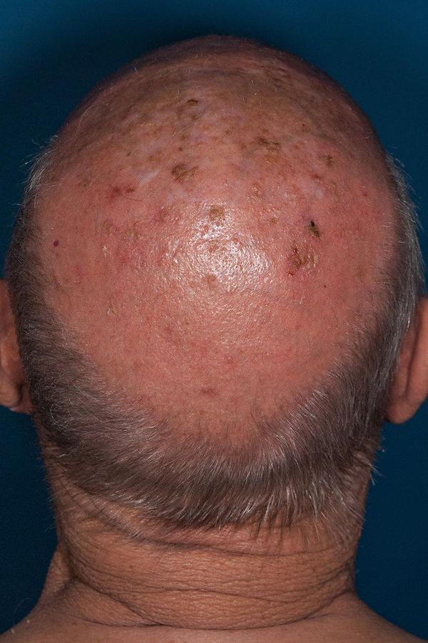 Actinic keratosis — example 2