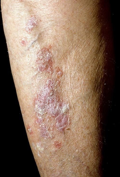 Bowen disease — example 1
